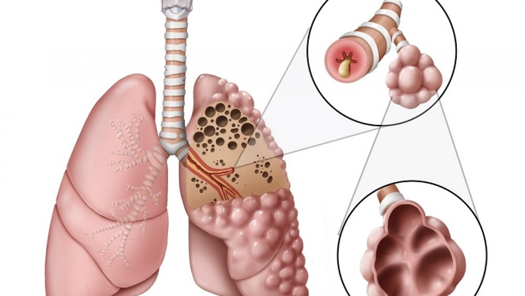 El EPOC , afecta a 7 de cada 10 argentinos y la mayoria lo ignora